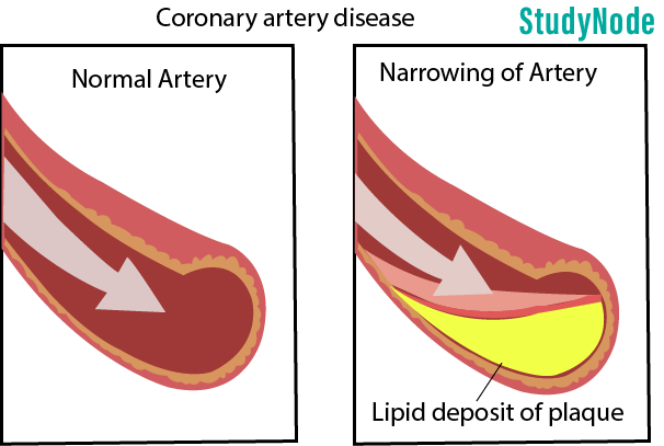 Conary-artery-disease.png