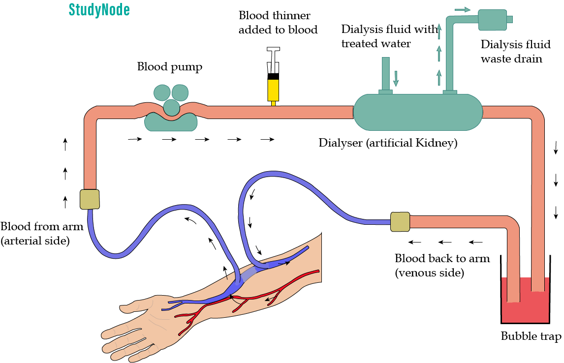 Dialysis-ki-prakriya-1