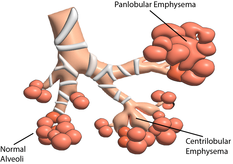 Emphysima-Respiratory-Disease.png